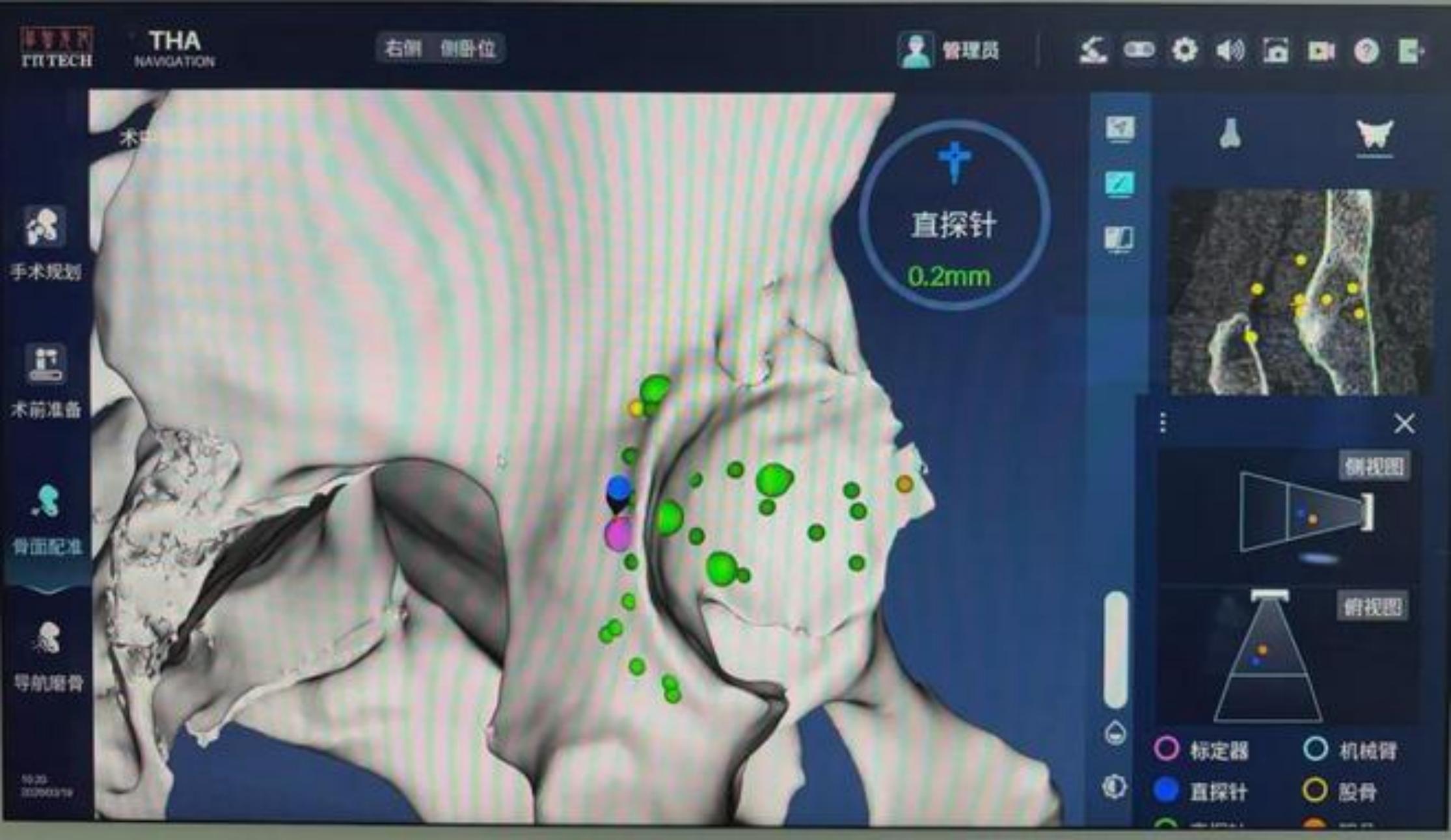 Nine Years of Avascular Necrosis: Kuntuo® Robot-Assisted 0.5mm Precision Reconstruction