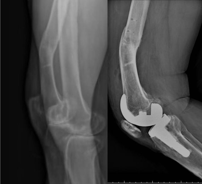 Robotic Assistance for Knee Replacement Surgery at PLA General Hospital