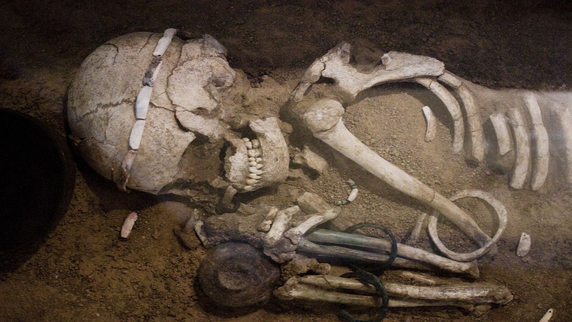 Medieval skeleton analysis suggests mercury was used as leprosy treatment