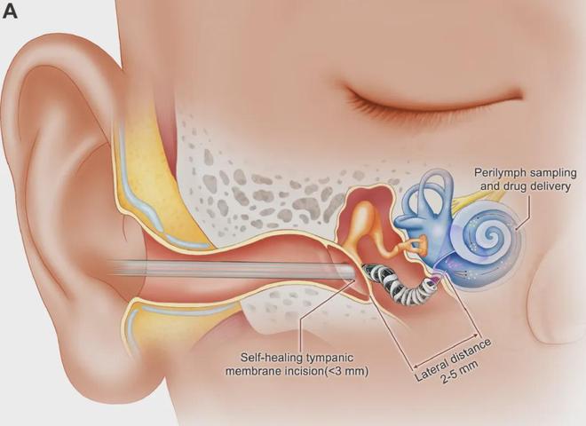 Innovative Minimally Invasive Inner Ear Surgery Robot Developed by Harbin Institute of Technology Team