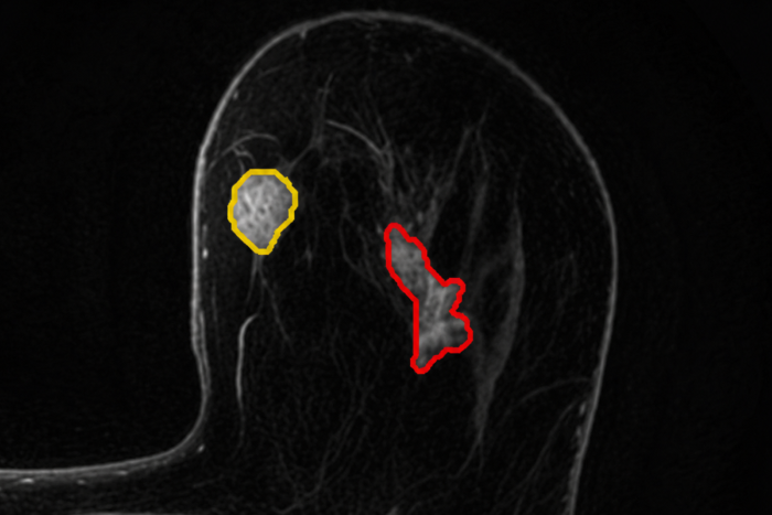 Quibim Launches CE and UKCA-Marked QP-Breast®, the First AI Tool to Detect Breast Cancer via MRI in Europe and the UK
