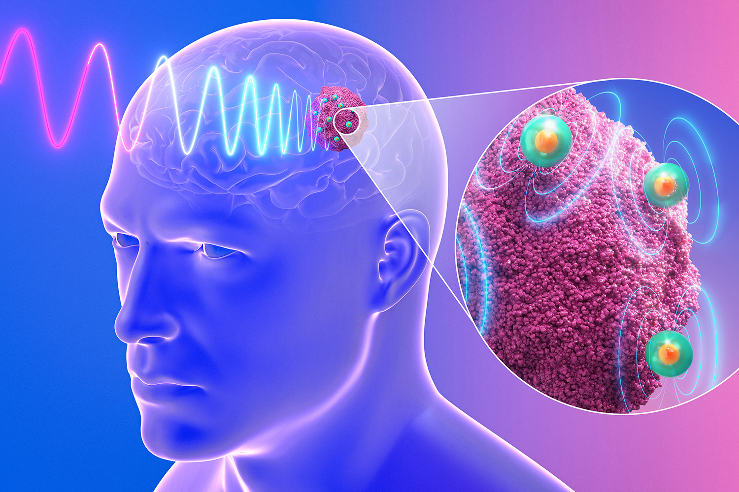MIT Media Lab Develops Injectable Nanoantennas for Treating Drug-Resistant Glioblastoma